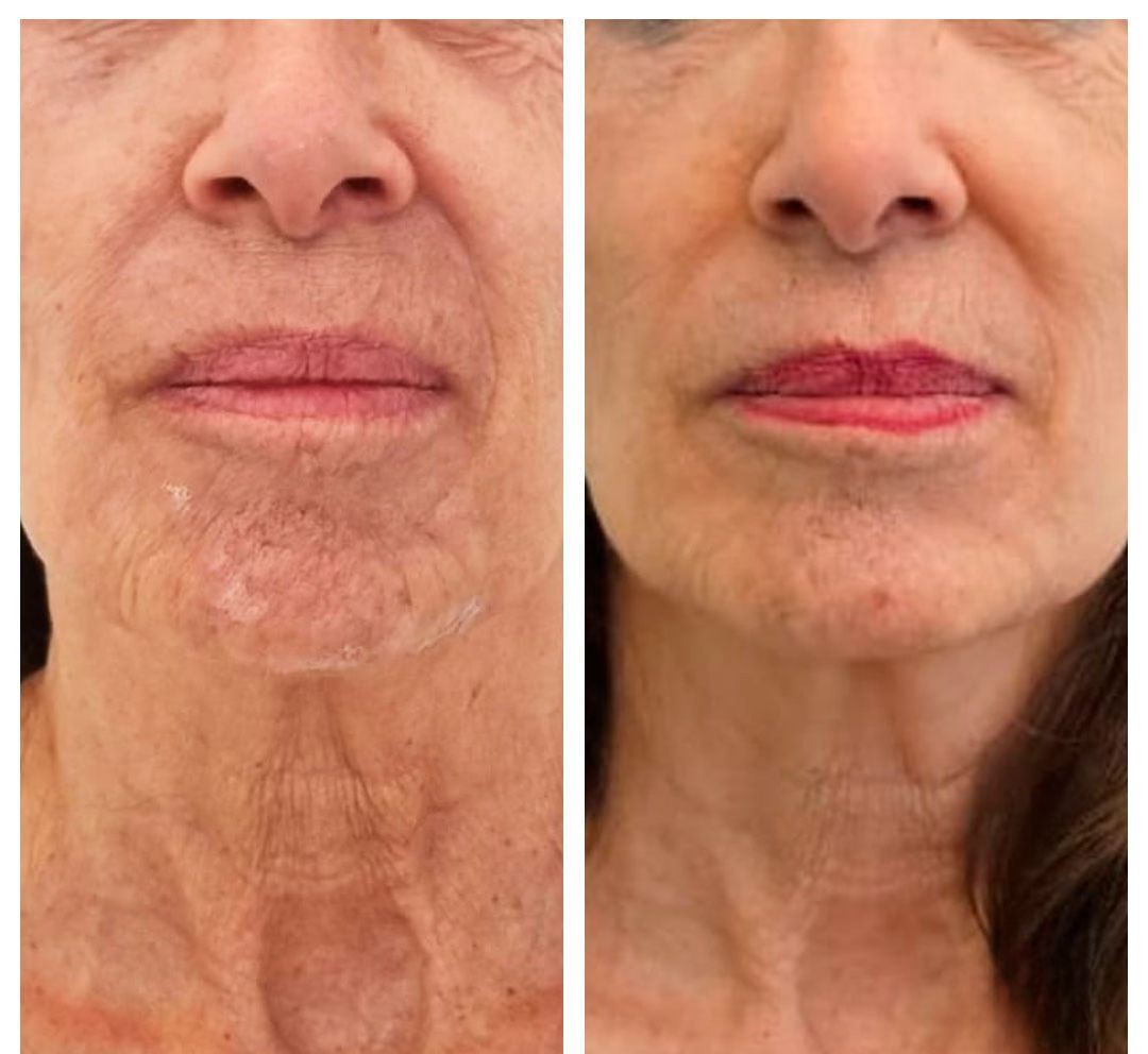 Tratamiento corporal